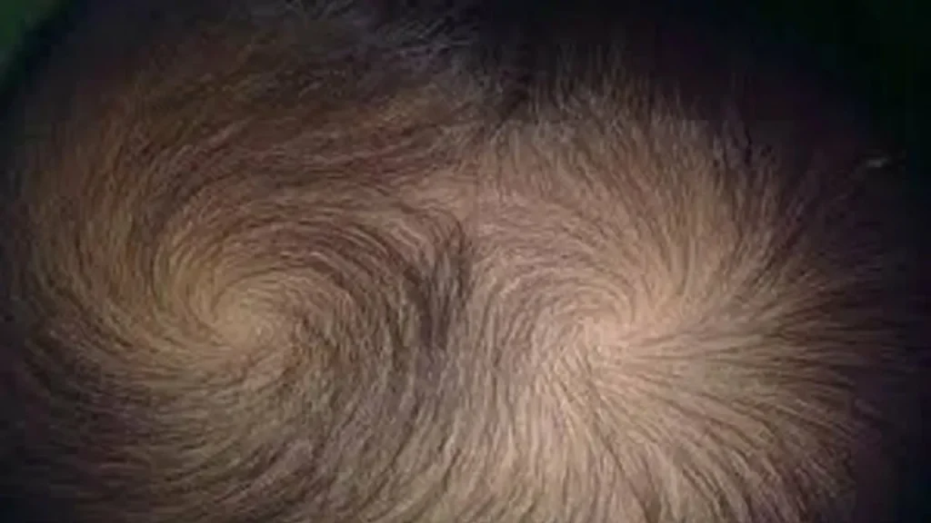 2 pusar di kepala kanak-kanak